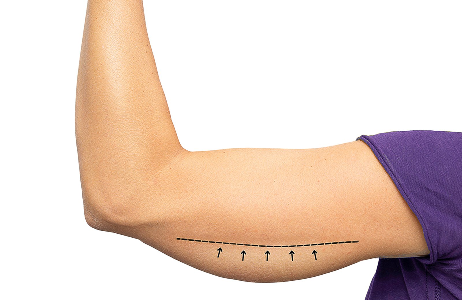 Arm Lift CASe final1