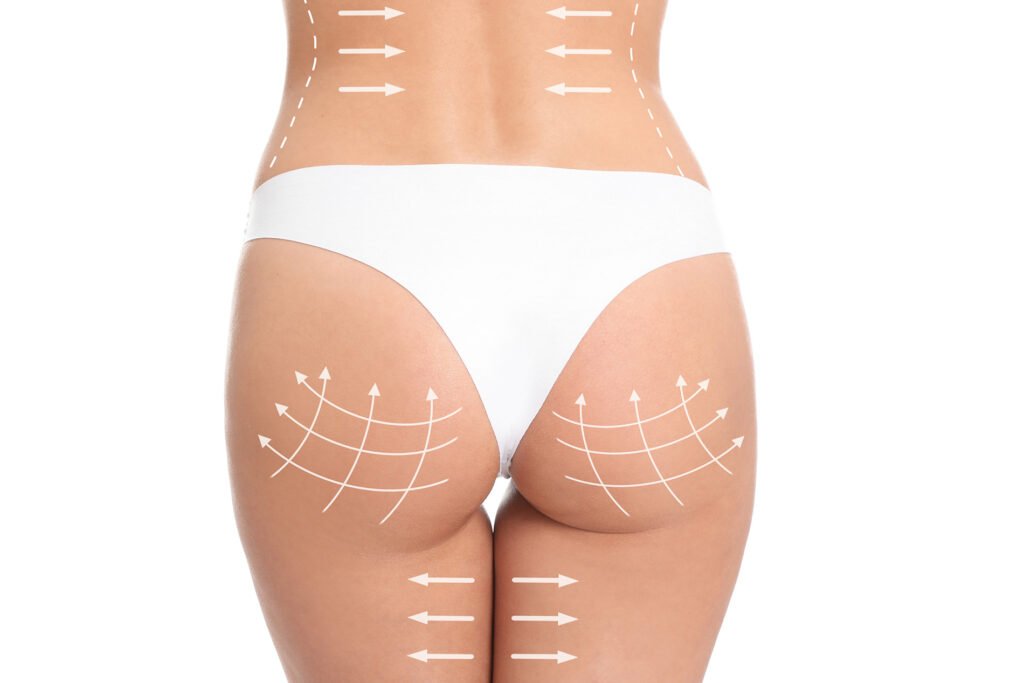 Buttock Augmentation final1