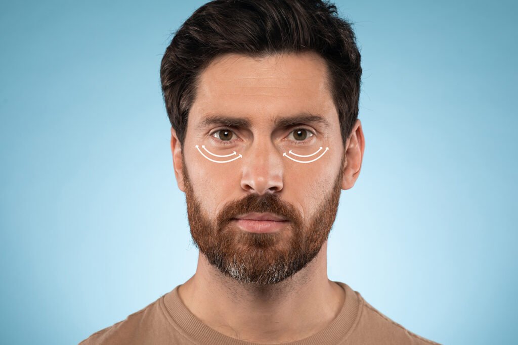 Eyelid Lift man final1