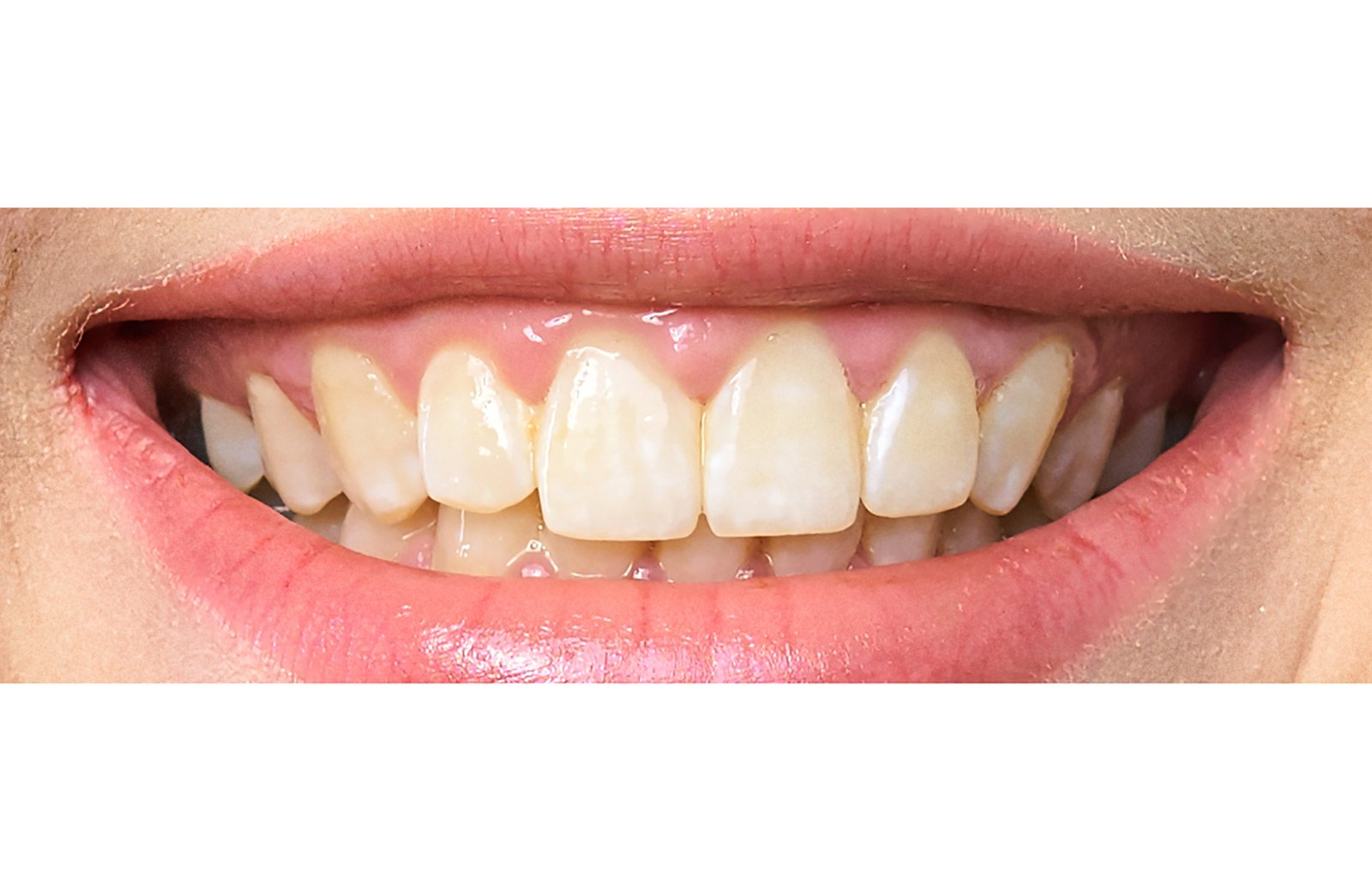 Hollywood Smile CASe final1